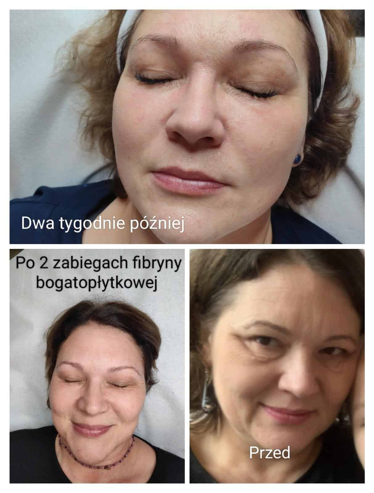 Zabieg regeneracyjny w gabinecie Sii Bello Śrem