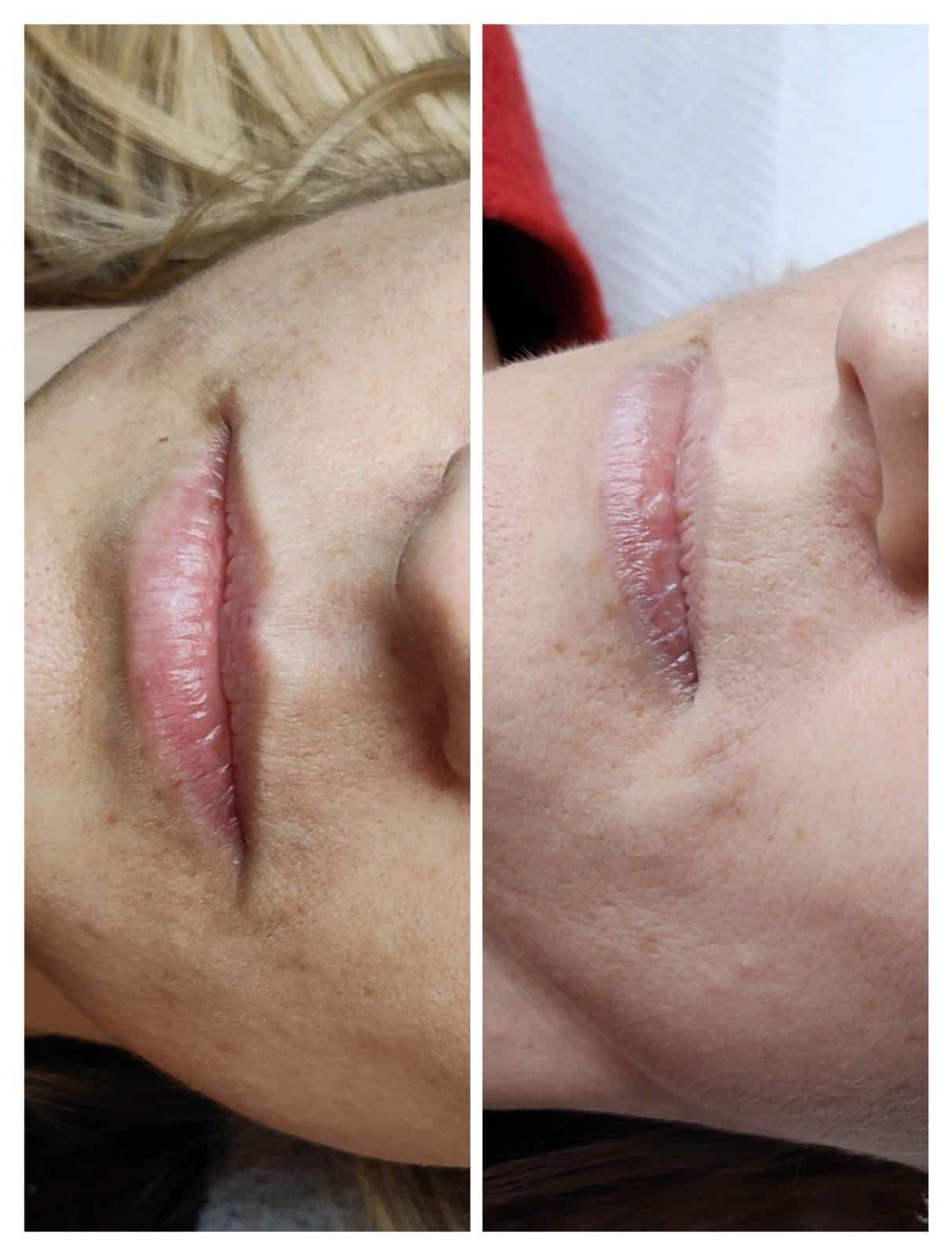 Efekt po zabiegu PRP