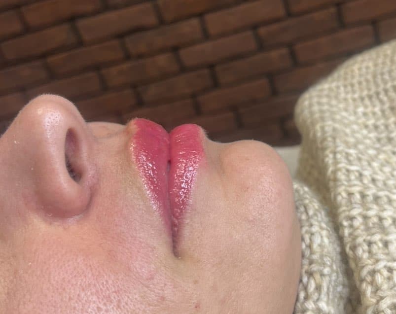 Efekt po powiększeniu ust 1ml – Sii Bello Śrem