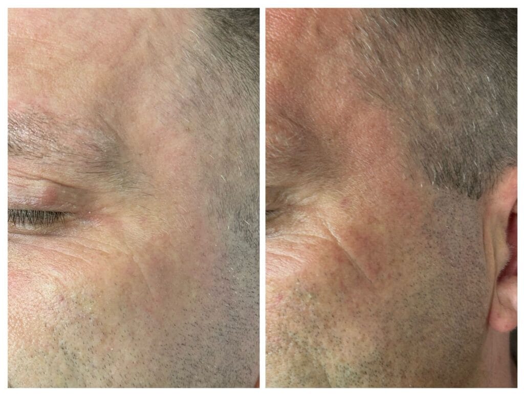 Efekt zabiegu fibryny bogatopłytkowej – zmniejszenie zmarszczek i odbudowa skóry