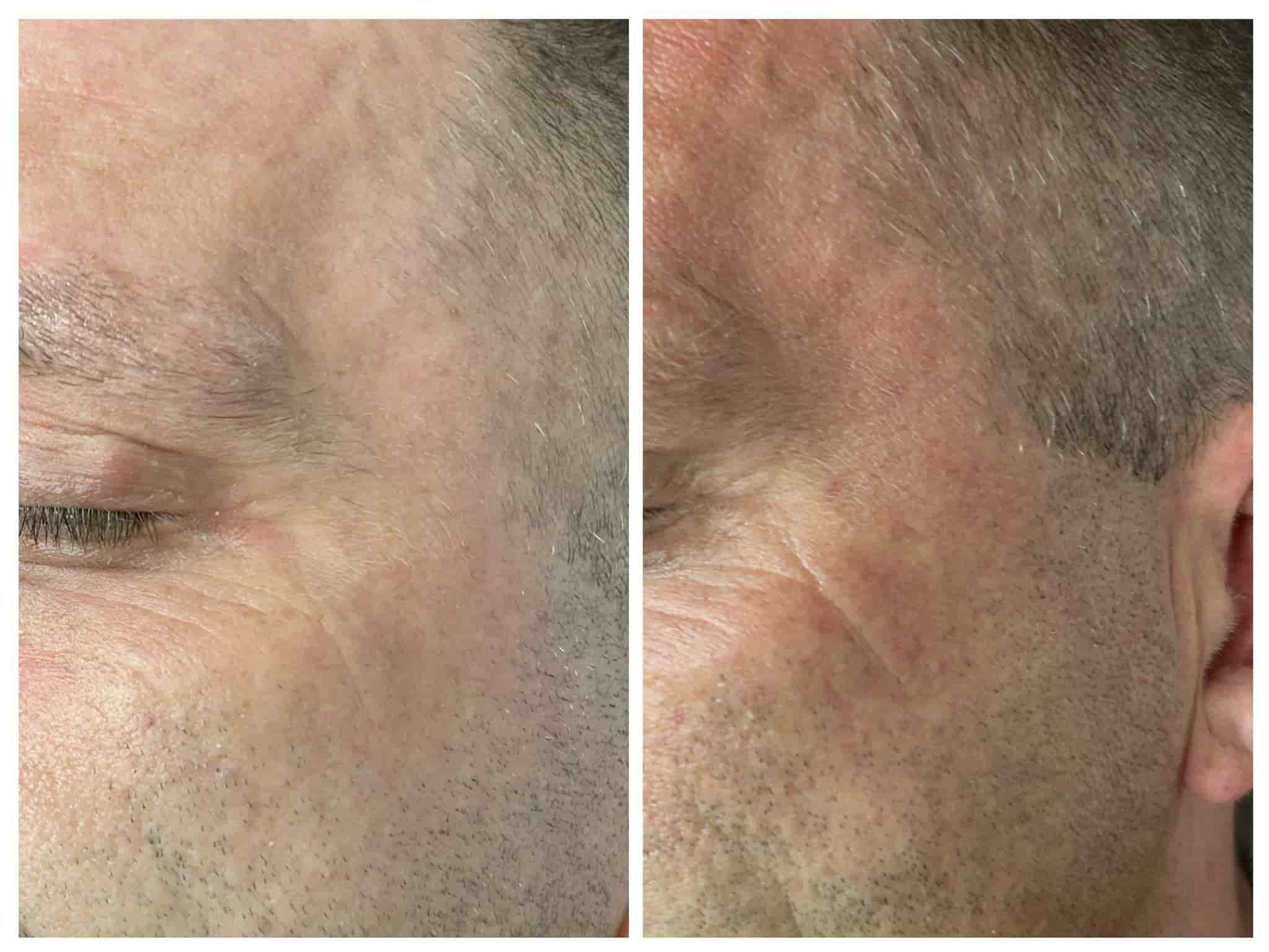 Efekt zabiegu MD Muscle